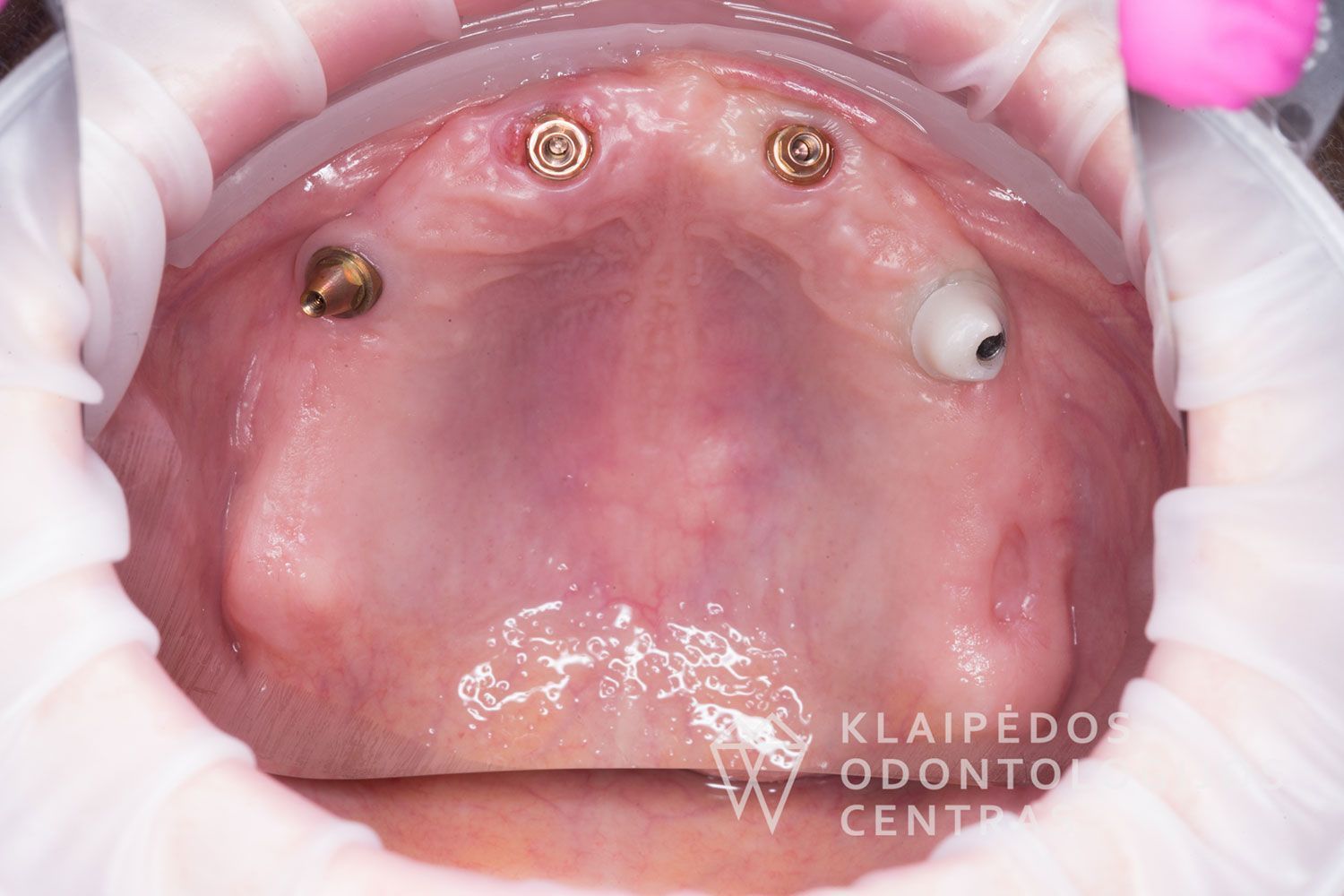 Cirkonio keramika ant 4 implantų