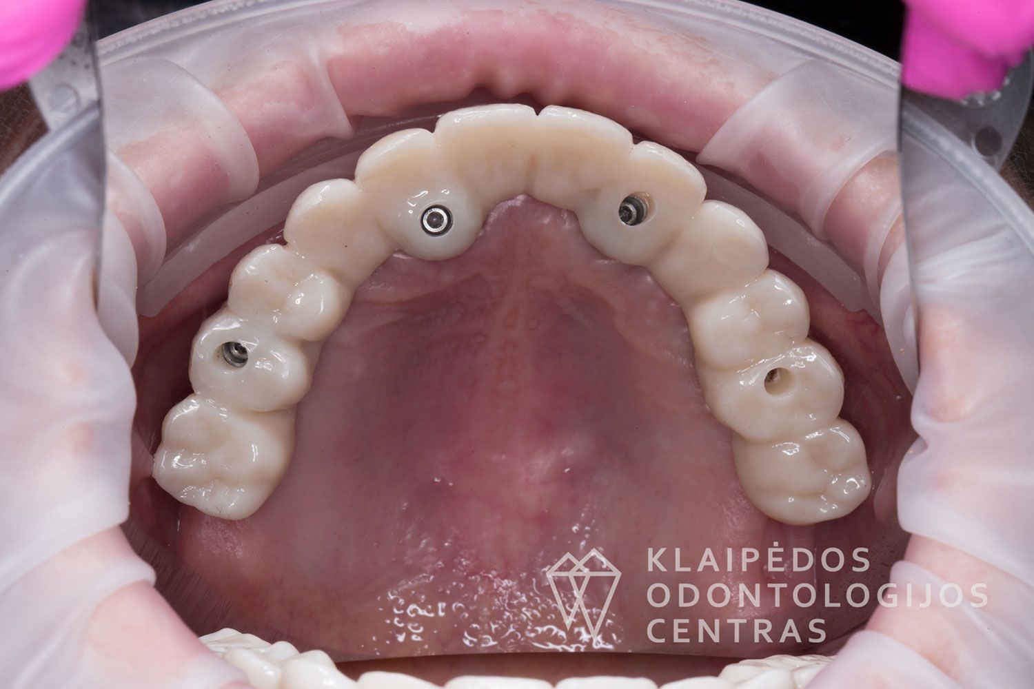 Cirkonio keramika ant 4 implantų