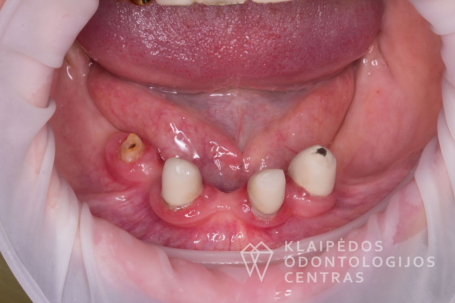 Cirkonio keramika ant 4 implantų