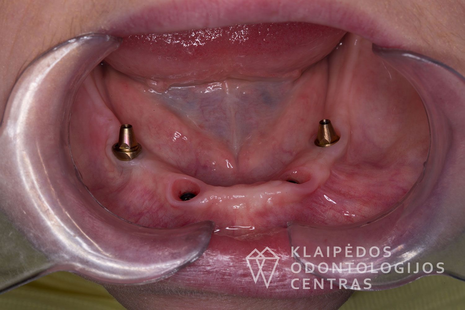 Cirkonio keramika ant 4 implantų