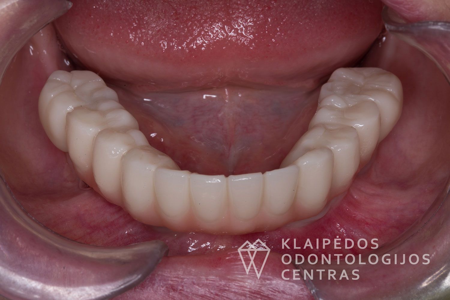 Cirkonio keramika ant 4 implantų