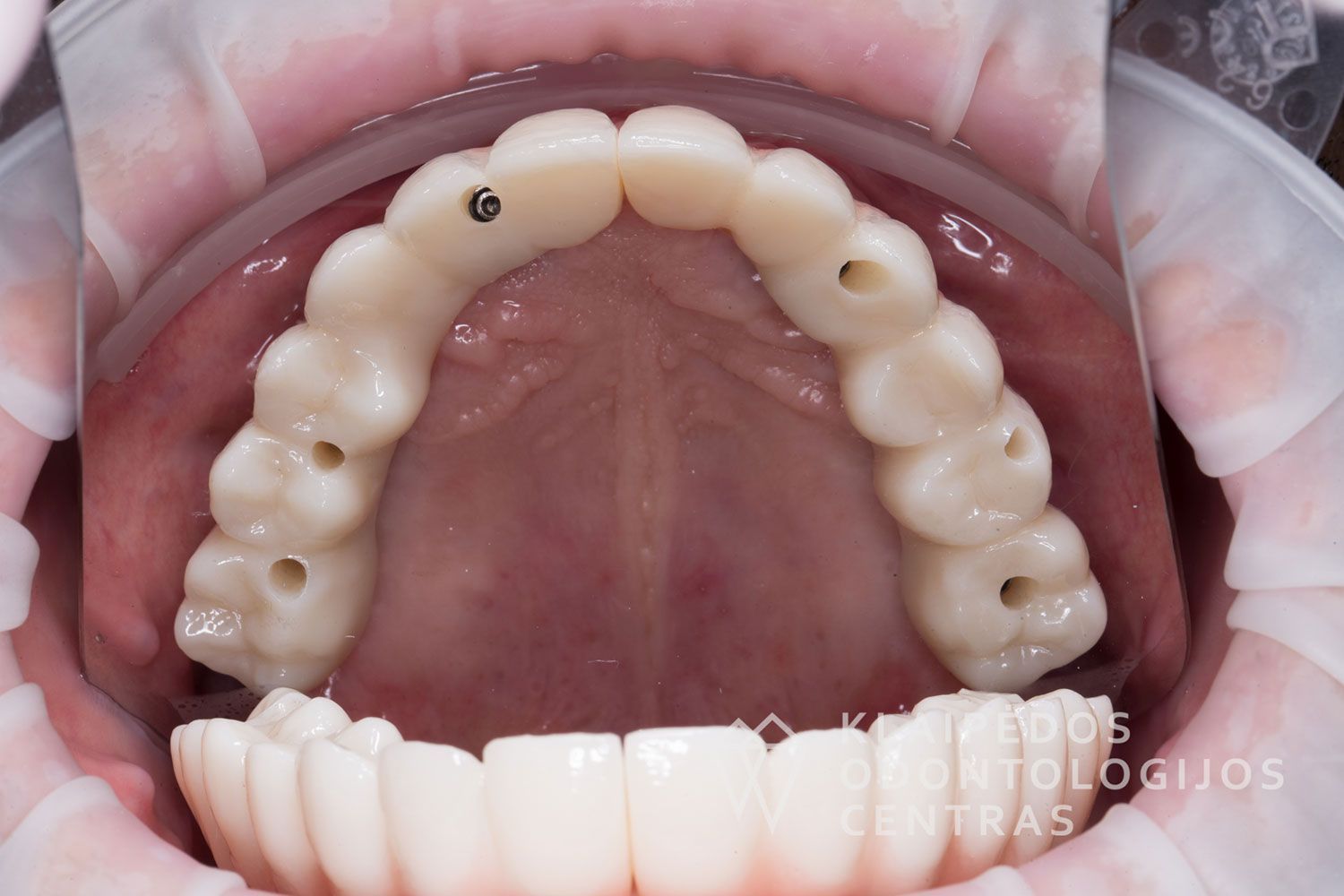 Cirkonio keramika ant 6 implantų