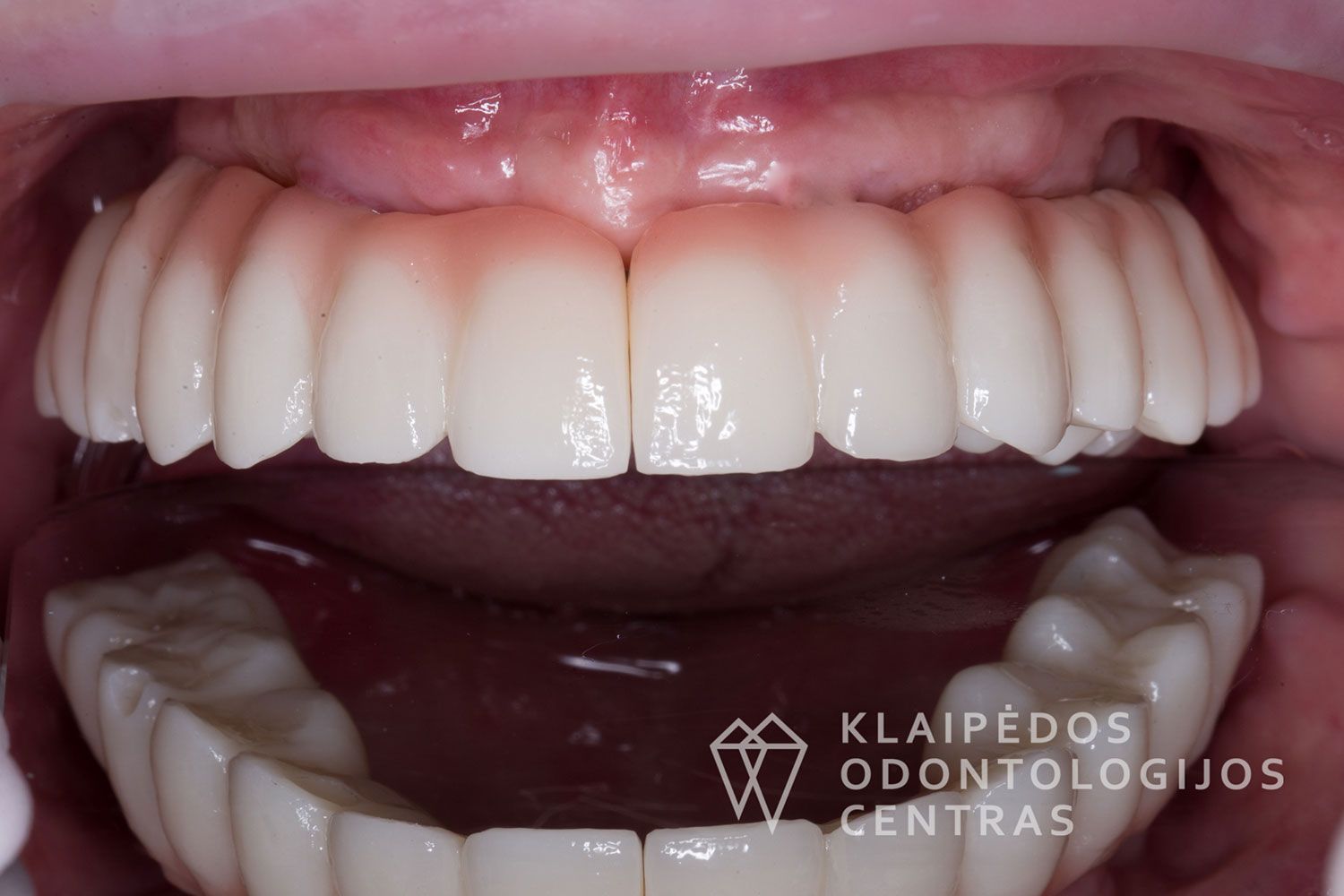 Cirkonio keramika ant 6 implantų