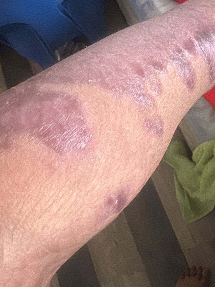 A close up of a person 's arm with a rash on it.