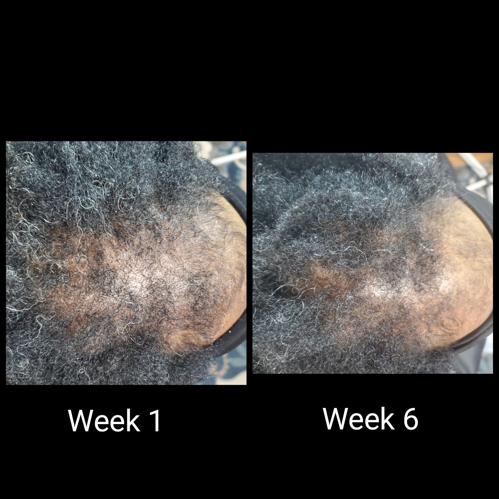 a before and after picture of a person 's hair growth .