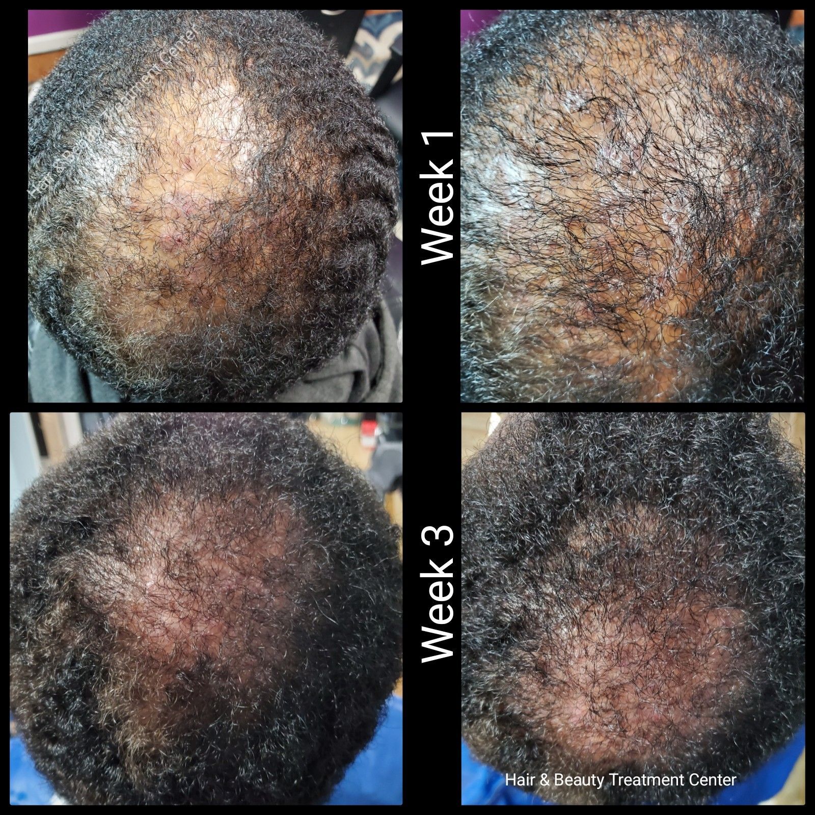 four images of a person 's head showing hair growth from week 1 to week 3