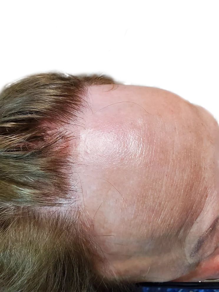 a close up of a man 's head with a bald spot on it .