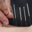 Acupuncture