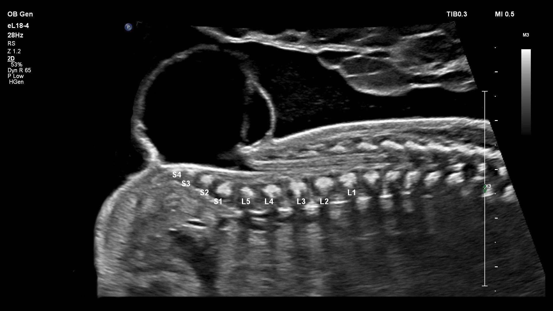 sonda de matriz linear PureWave da Philips eL18-4
