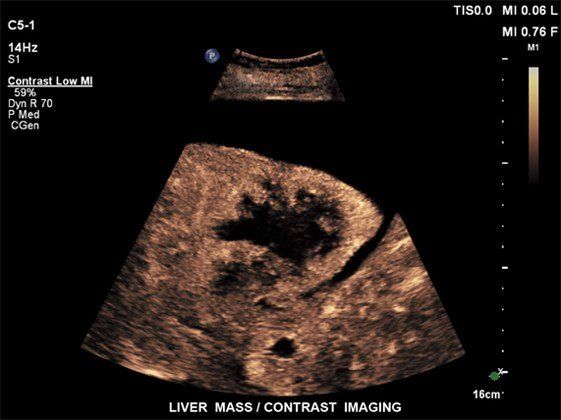 Contrast Enhanced Ultrasound