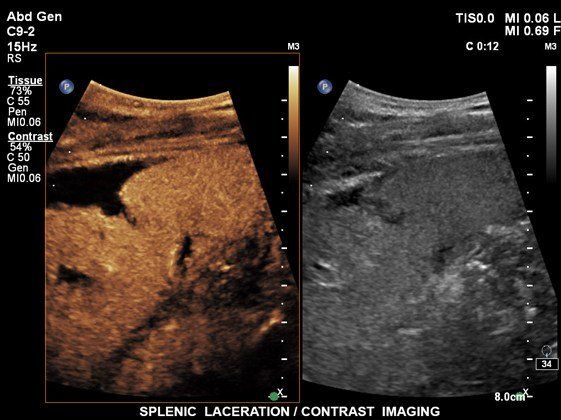 Contrast Enhanced Ultrasound