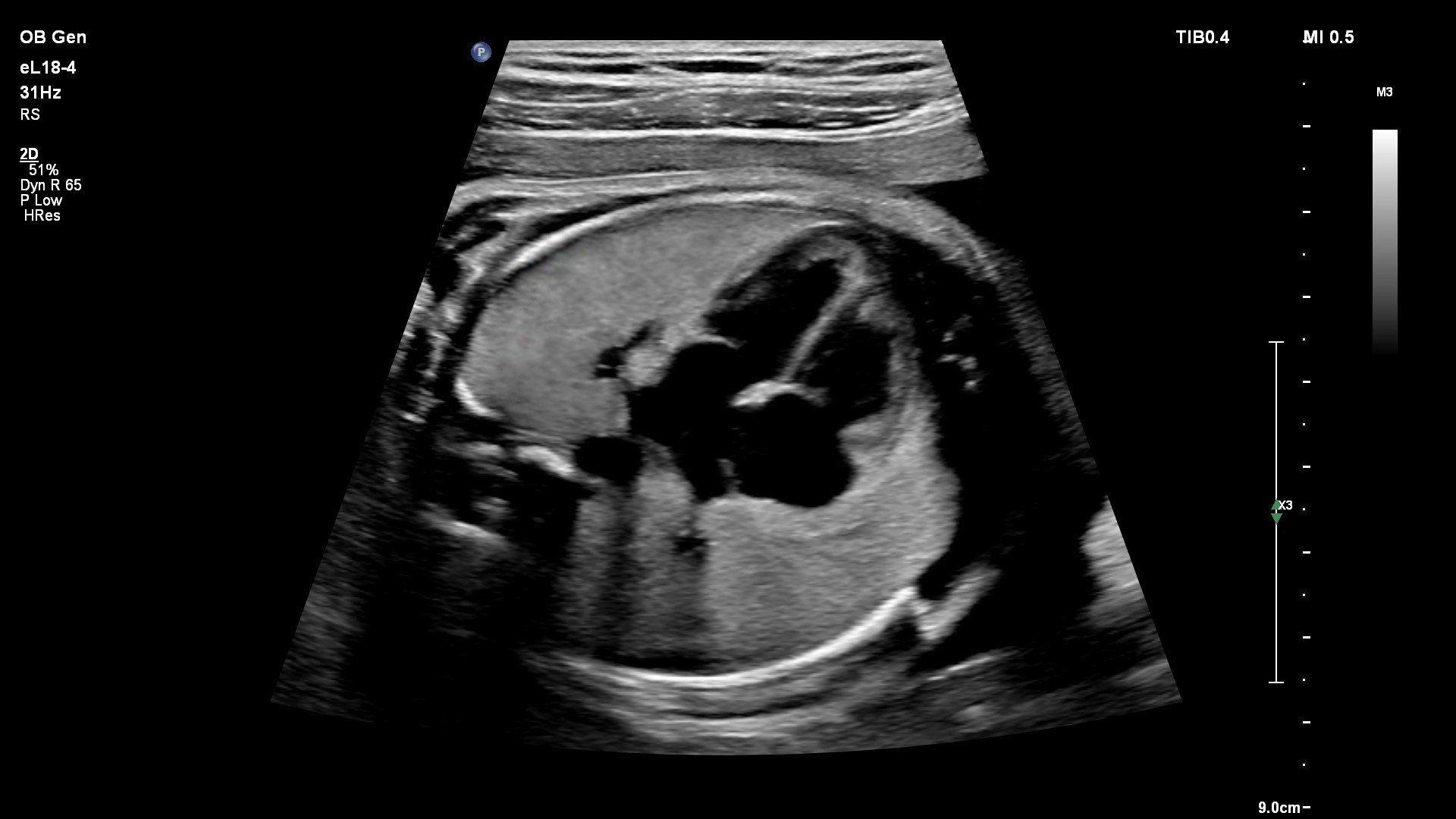 sonda de matriz linear PureWave da Philips eL18-4