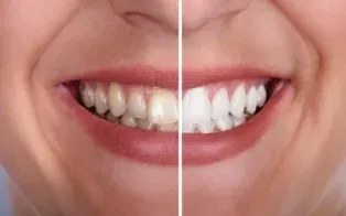 comparison des dents avant et après blanchiment, montrant les dents jaunâtres à gauche et blanches à droite.