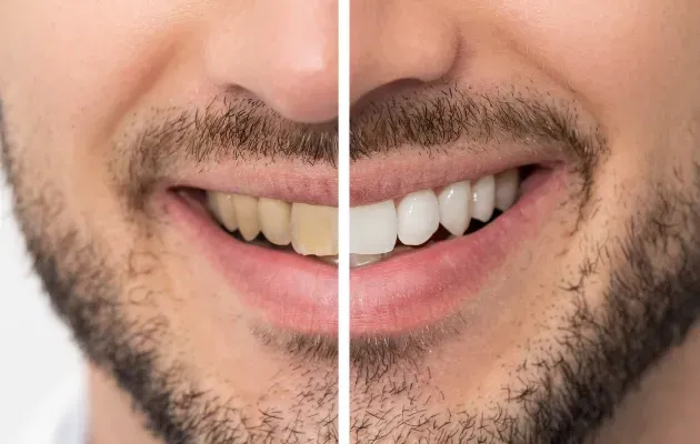 Comparaison avant/après blanchiment dentaire professionnel à Marrakech