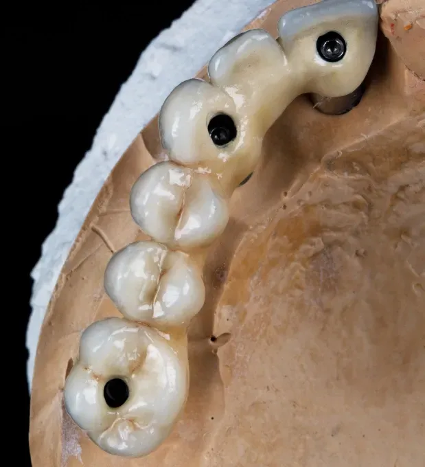 Bridge sur implants dentaires – solution prothétique durable à Marrakech