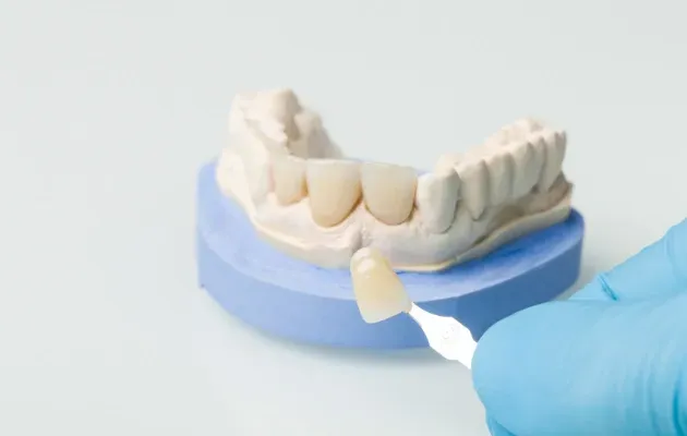 Résultat de facettes dentaires en céramique réalisées par le Dr Belgmair Omar à Marrakech