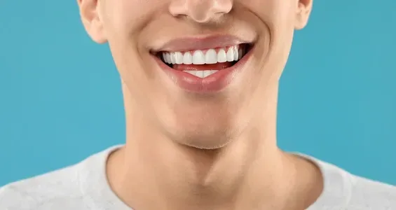 Résultat de facettes dentaires en céramique réalisées par le Dr Belgmair Omar à Marrakech