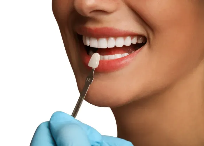 Facettes dentaires sur modèle de travail – cabinet L'Atelier du Sourire à Guéliz