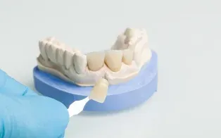 Une main gantée tient un nuancier dentaire à côté de couronnes en céramique sur un modèle dentaire.