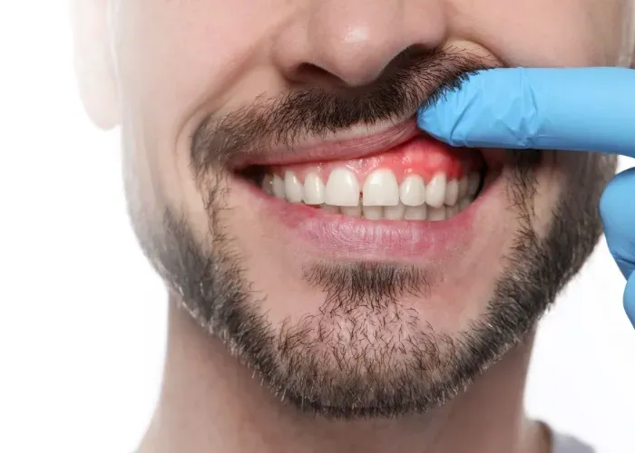 Une main gantée soulève la lèvre supérieure d'une personne pour révéler des gencives gonflées, rouges et enflammées.