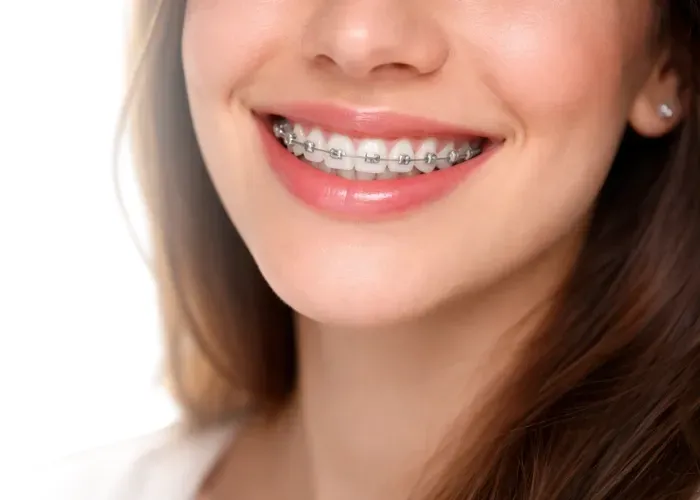 Gros plan sur une bouche souriante montrant des dents avec un appareil dentaire en métal argenté.