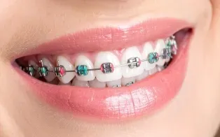 Gros plan sur une bouche souriante montrant des dents avec des appareils dentaires métalliques et des élastiques colorés.