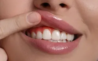 Une personne relève sa lèvre supérieure pour montrer ses gencives rouges et enflammées autour de ses dents de devant.