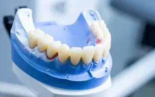 Une prothèse dentaire en bridge, fixée sur un modèle de mâchoire inférieure, montrant des dents artificielles sur mesure.