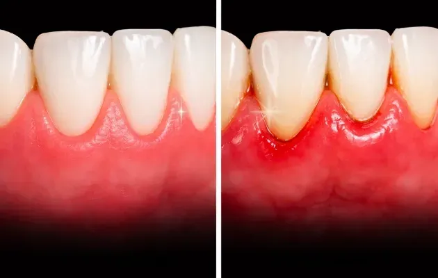 Vue en deux parties comparant des gencives saines à gauche et des gencives enflammées, rouges et gonflées à droite.