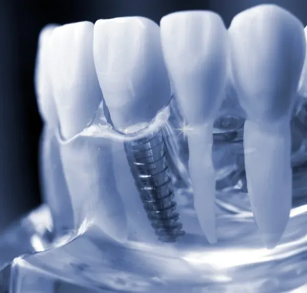 Couronne dentaire en zircone esthétique réalisée au cabinet L'Atelier du Sourire à Guéliz