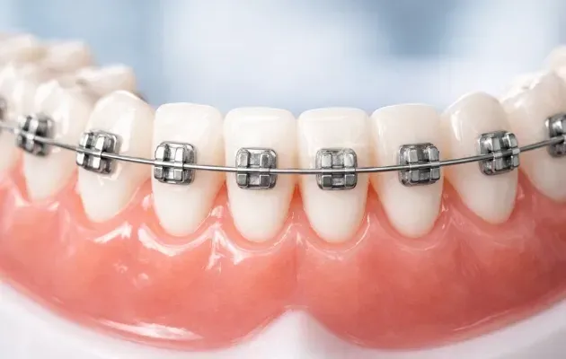 Gros plan d'un modèle dentaire montrant des dents propres et blanches avec des appareils orthodontiques métalliques.