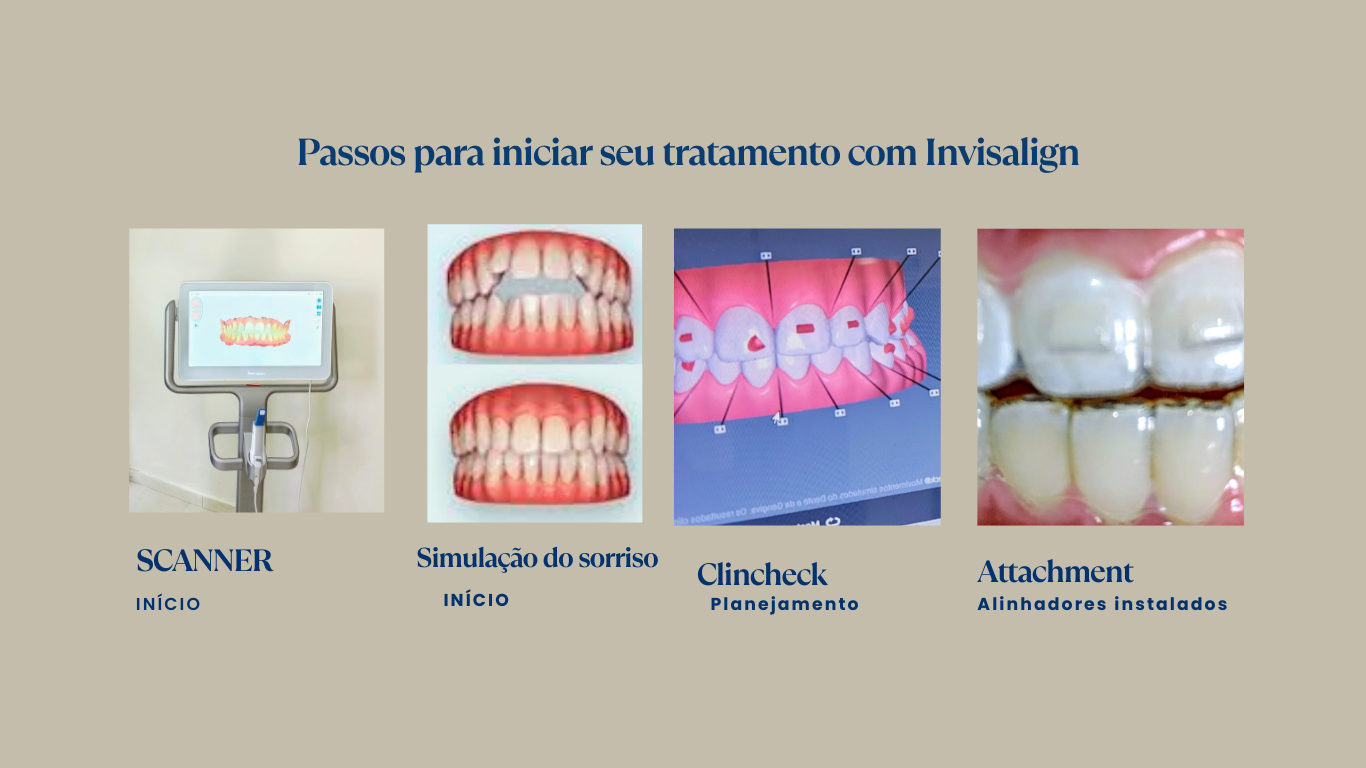 Passos para iniciar seu tratamento com alinhadores invisalign 