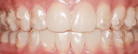 attchments instalados para iniciar tratamento com Invisalign 
