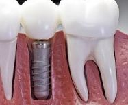 Implante Um diagrama em close-up mostra um implante dentário inserido no osso maxilar, suportando uma coroa dentária artificial.