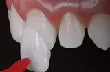 Estética Dental lentes de contato facetas