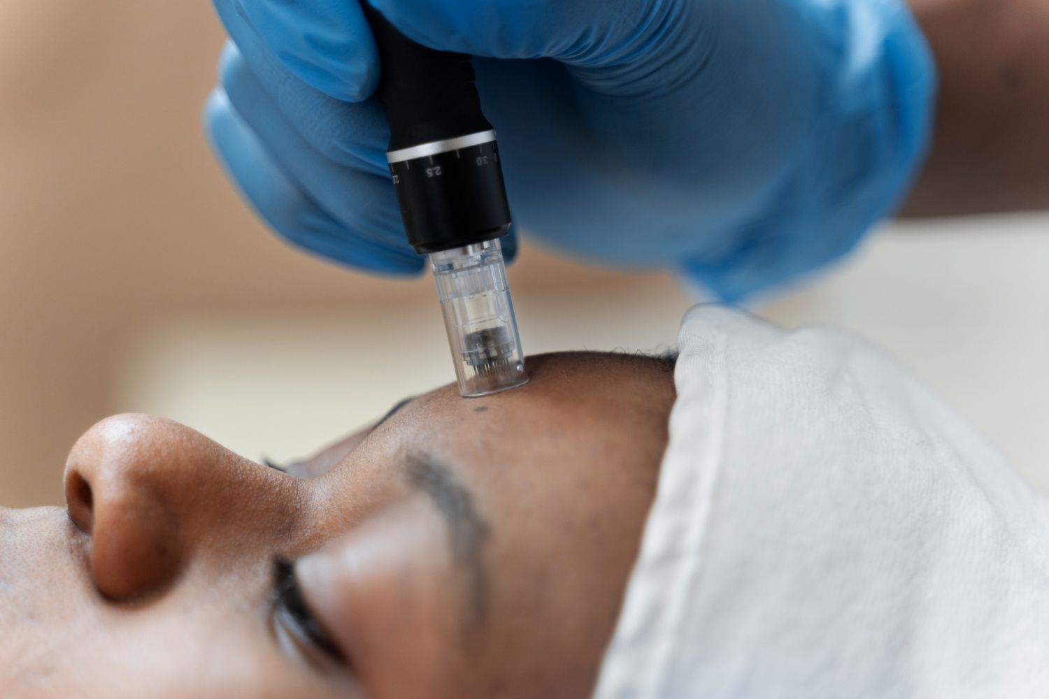 Gloved hand performing a facial microneedling treatment on a client lying down with a towel on the head
