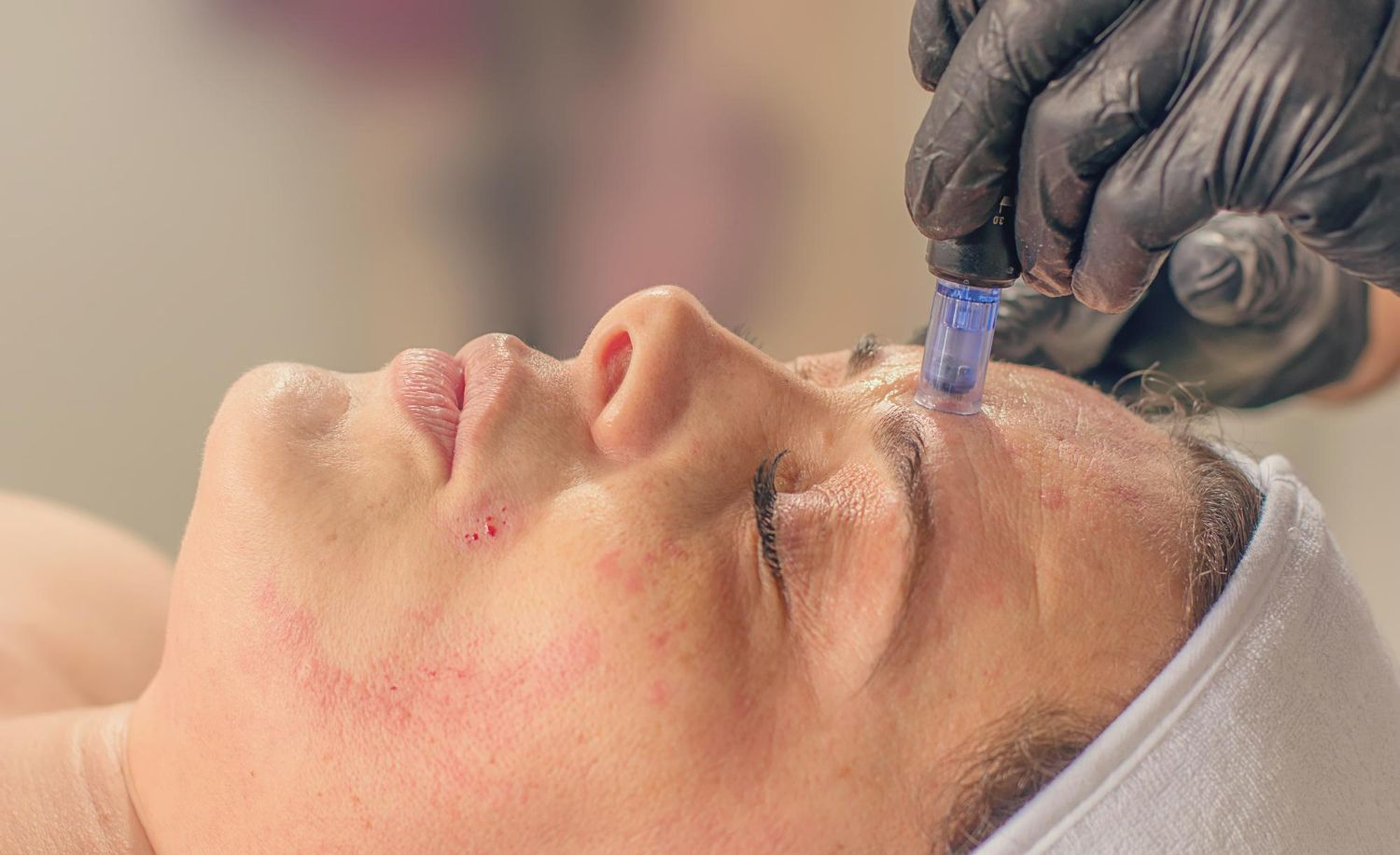 Close-up of a person undergoing a facial microneedling treatment; small device with blue liquid penetrates skin.
