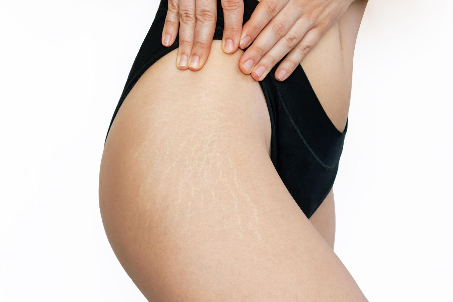 A person's side with stretch marks on their thigh, wearing black underwear, hands on hips.