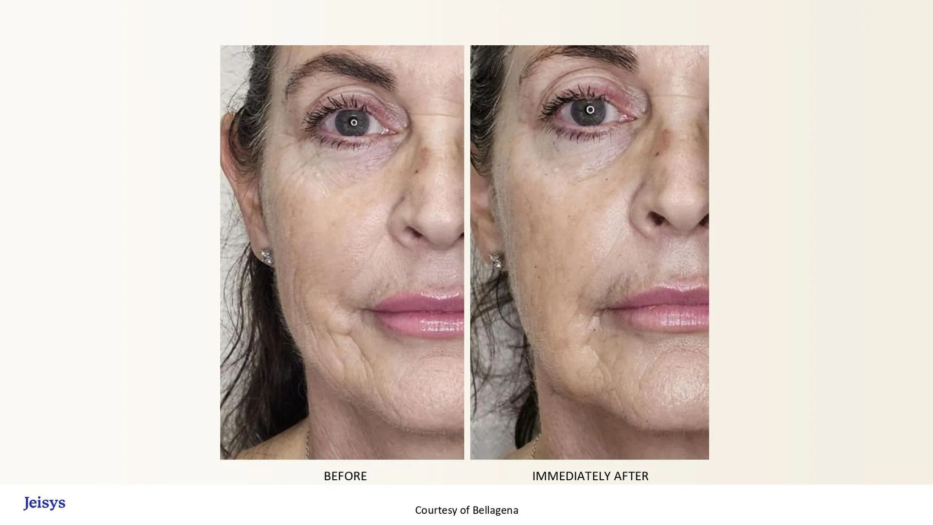 Side-by-side close-up face comparison showing skin and eye-area changes before and after treatment.