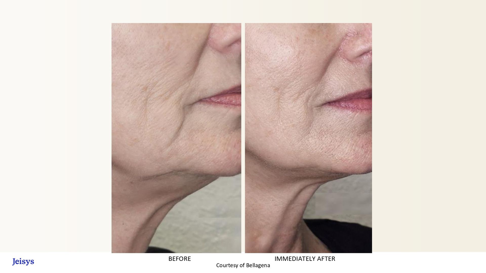 Before-and-after showing reduction of neck wrinkles on woman. Left side has more wrinkles. Right shows smoother skin.