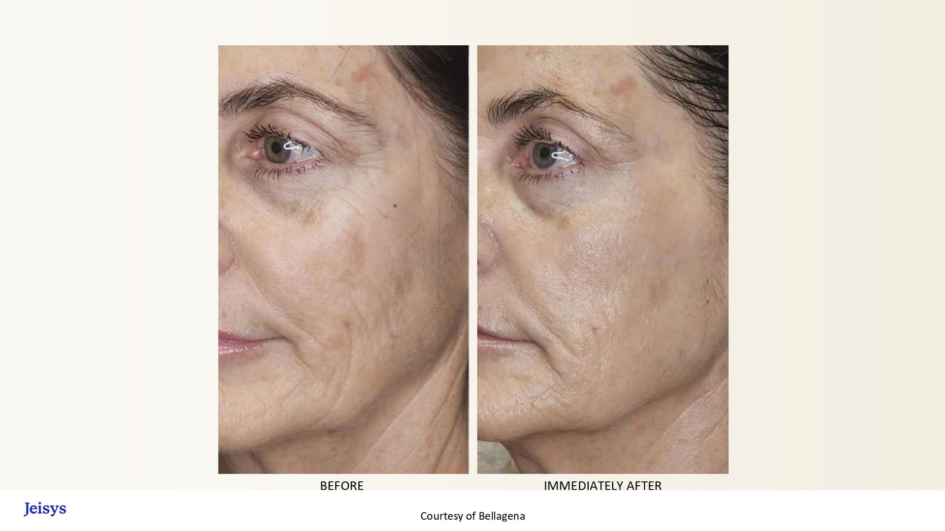 Side-by-side comparison of woman's face before and after skincare treatment, showing reduced wrinkles and improved skin tone.
