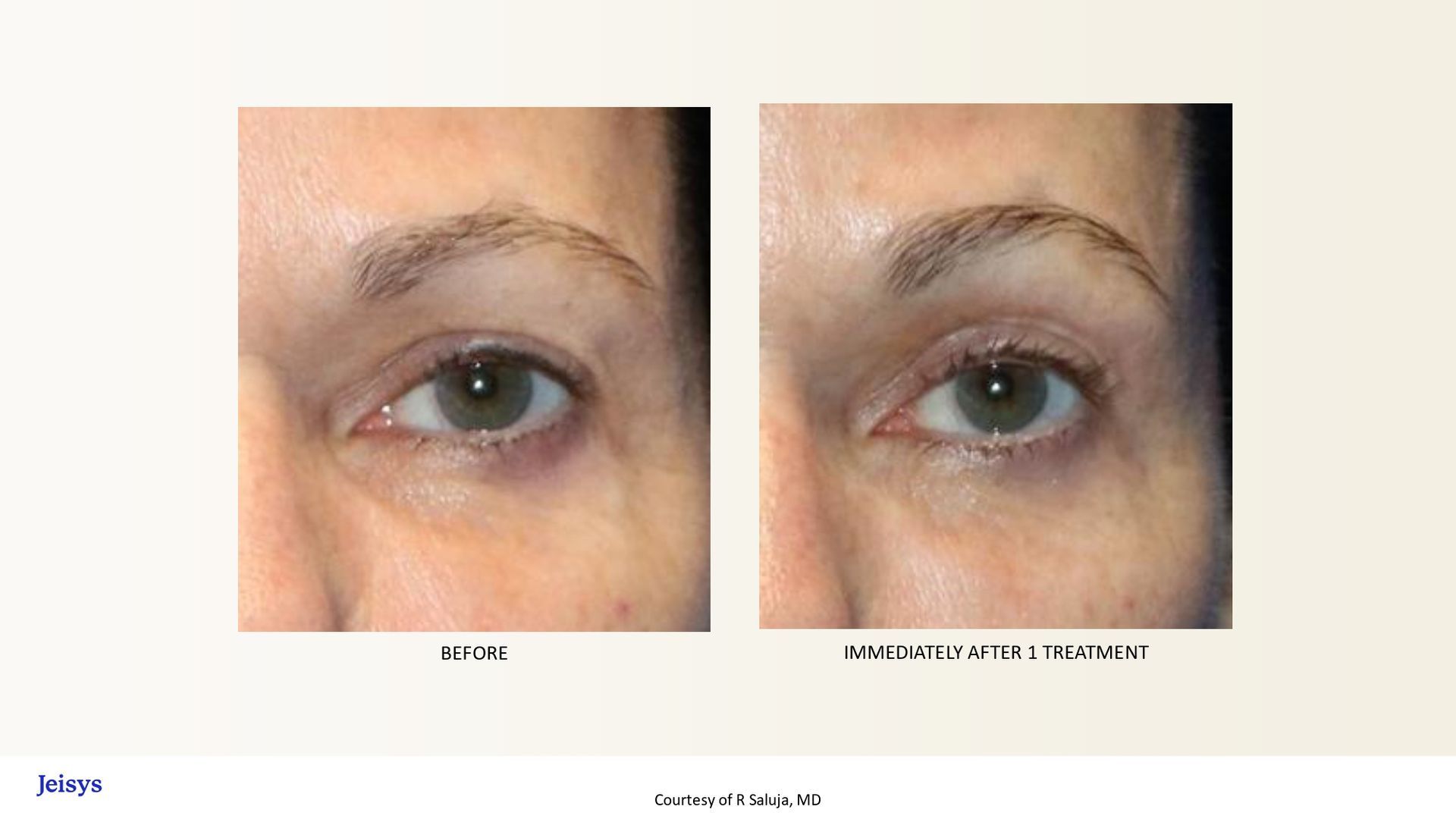 Before and after photos of a person's eyes, showing reduction of wrinkles with a procedure.