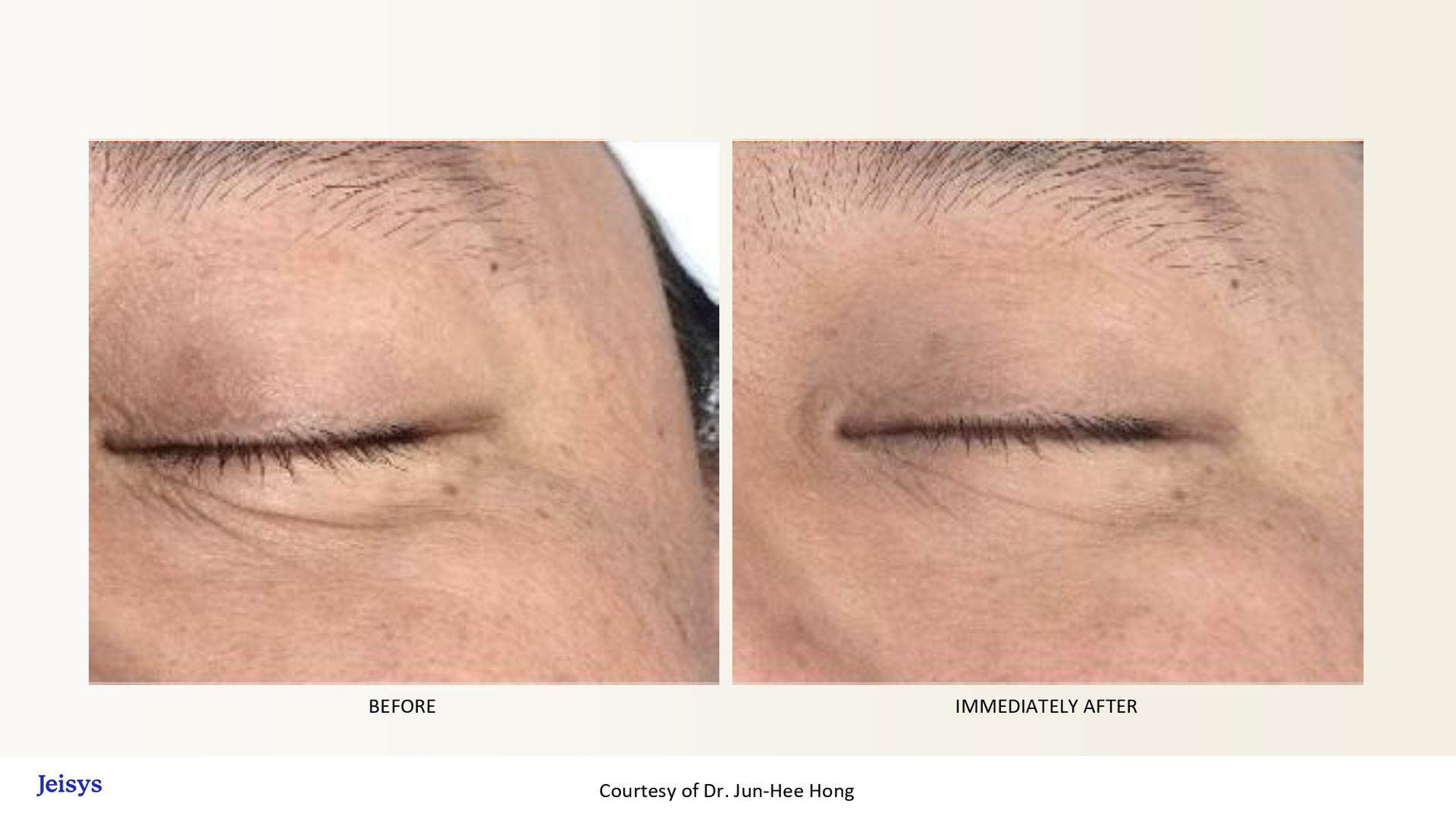 Side-by-side comparison of a closed eye before and after cosmetic treatment.