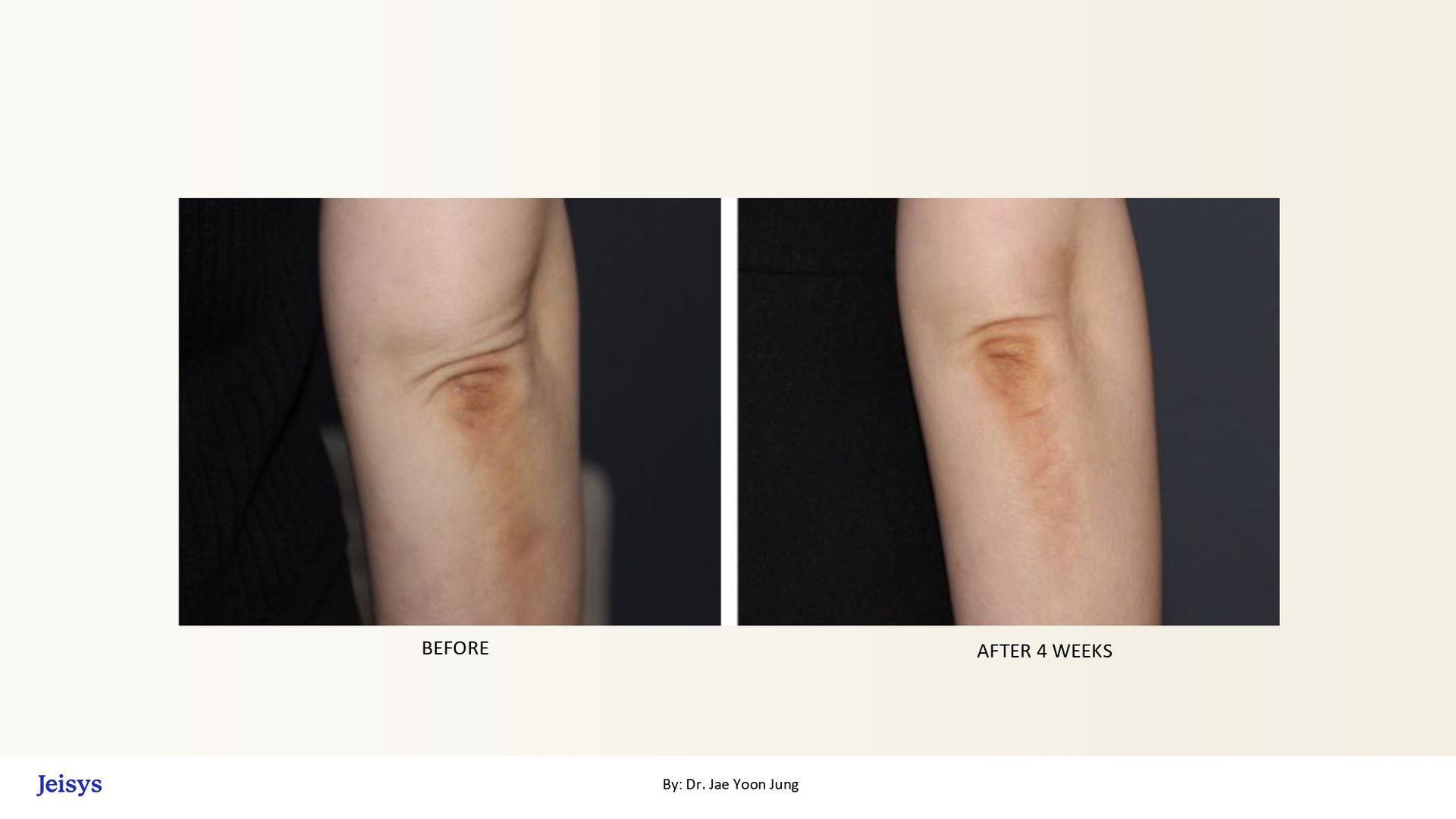Before-and-after comparison: Arm skin before and after a procedure, showing wrinkle reduction.