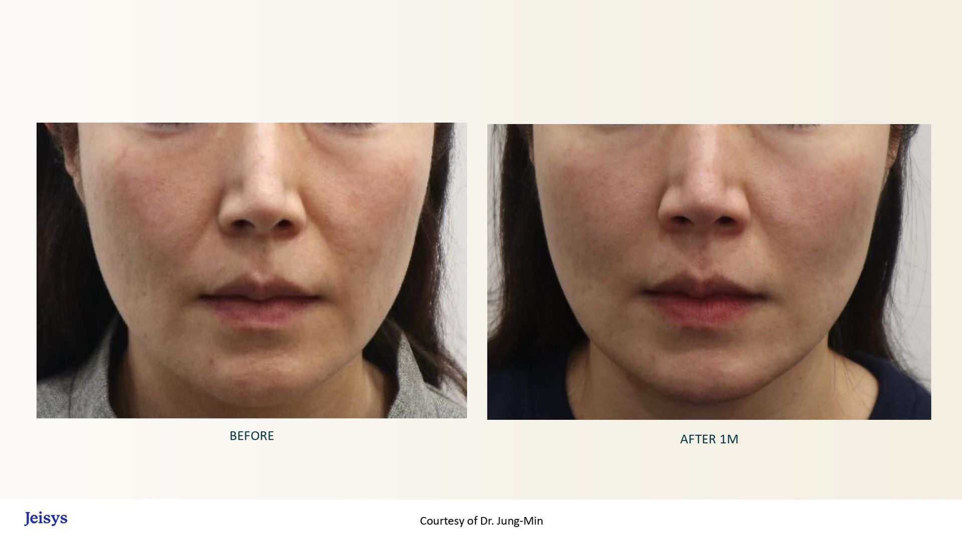 Side-by-side comparison of a woman's face. Before and after photos showing reduced nasolabial folds.