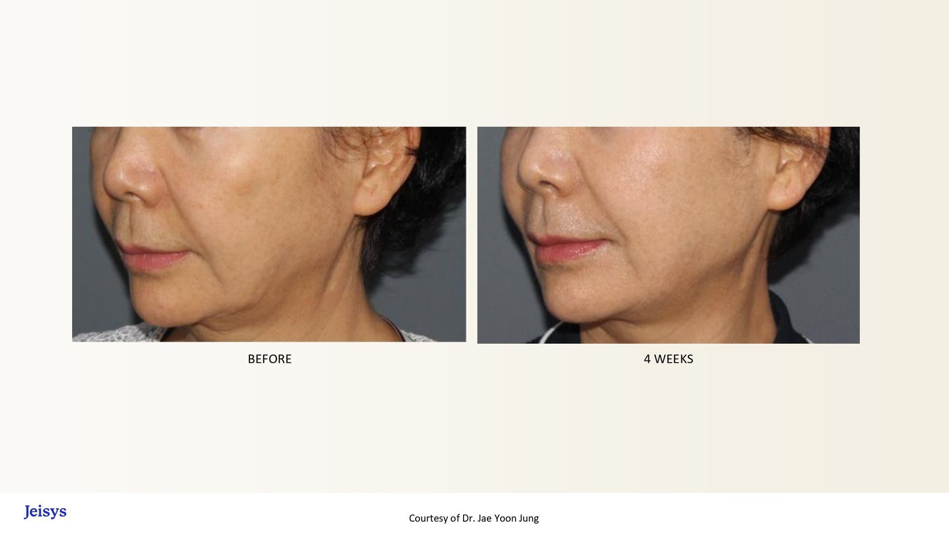 Before and after photos showing skin tightening around a woman's neck and jawline.