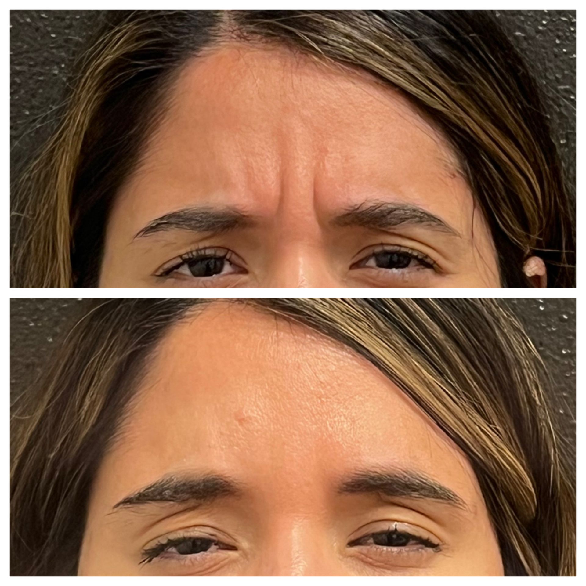 a before and after photo of a woman 's forehead with wrinkles .