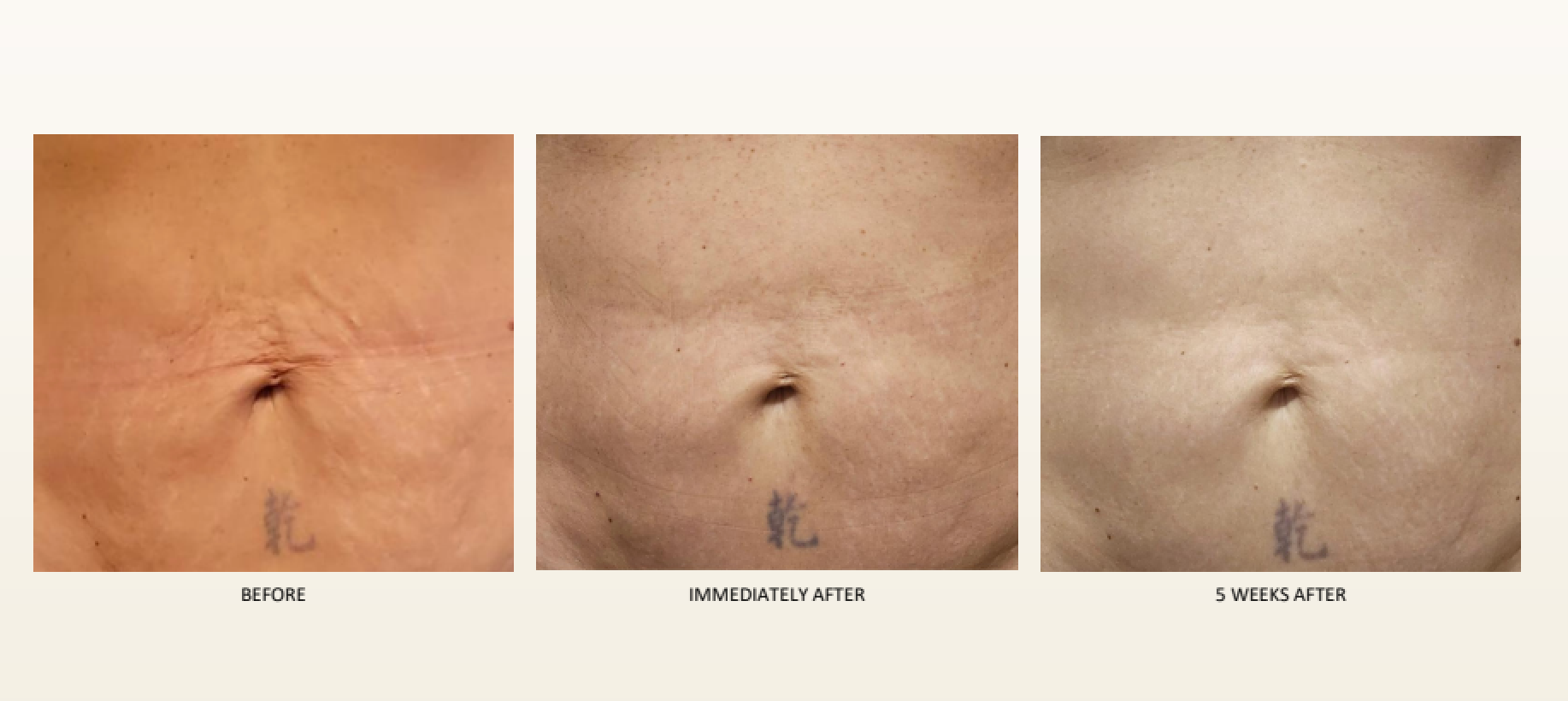 Comparison of a person's abdomen before and after treatment, showing improvement in skin texture and reduced lines.