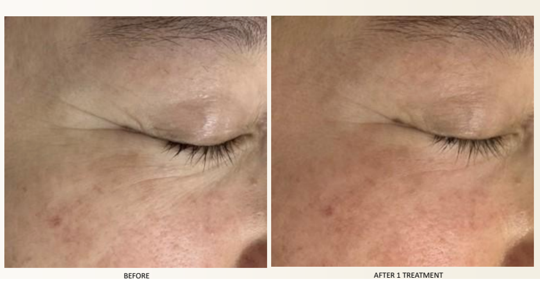 Before-and-after comparison of a person's eye area, showing reduced wrinkles after treatment.