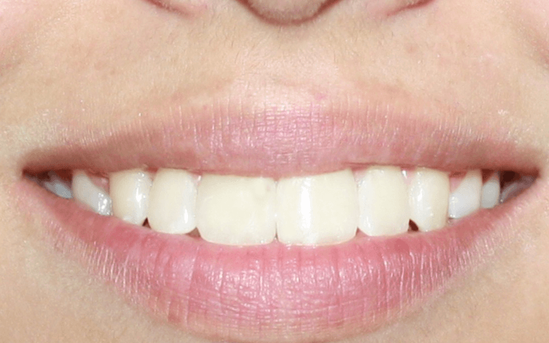 Smile After Orthodontic treatment in Montebello Nueva Smile